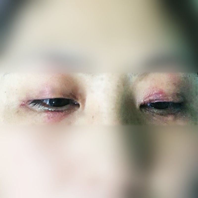 眼皮过敏红肿痒眼皮干燥起干皮痒发红发痒眼皮上长小疙瘩起癣痒