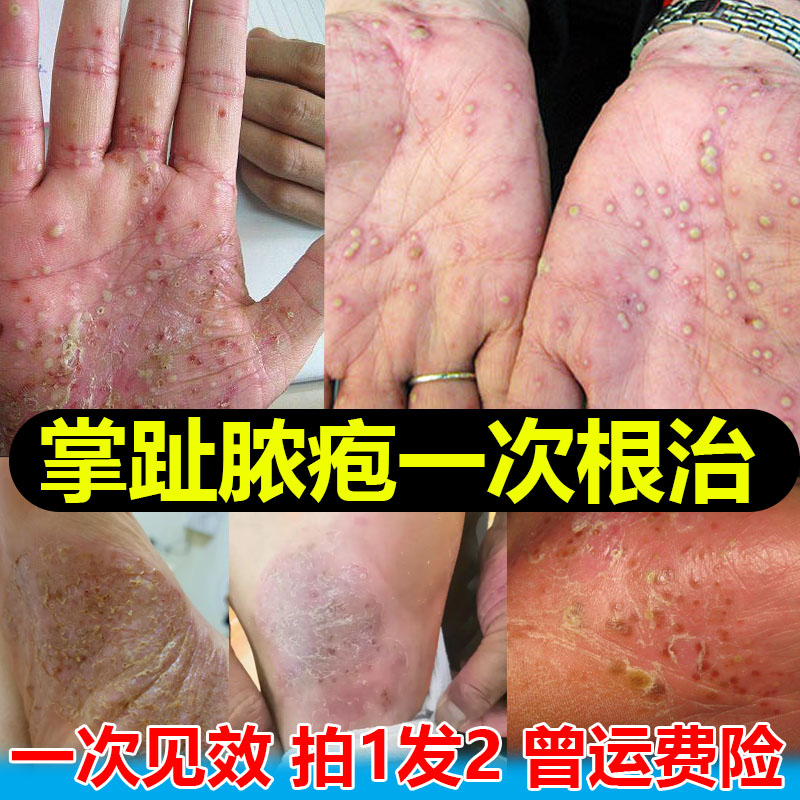 掌趾脓疱病症专用药治疗手脚脓包角化病蜕皮掌跖脓包干裂脱皮红斑