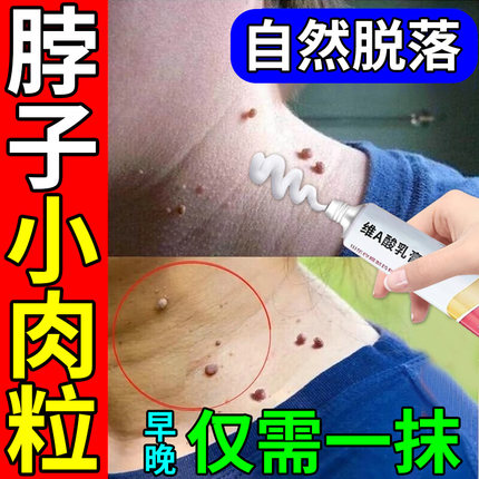 维a酸乳膏医用去疣官方旗舰店扁平疣去除膏脖子上长小肉粒丝状疣