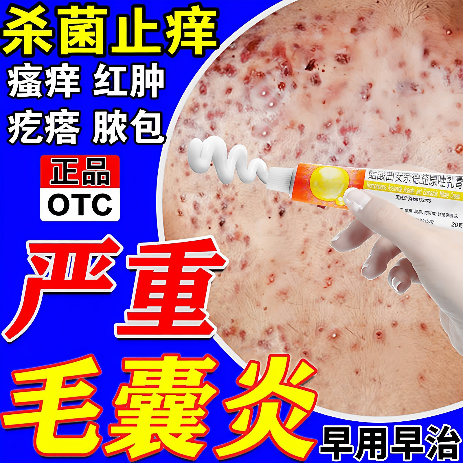 【999】曲安奈德益康唑乳膏0.1%1%*20g*1支/盒