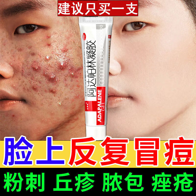 阿达帕林凝胶正品官方旗舰店医用青少年祛痘毛孔粗大去黑头