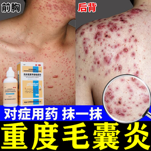 治疗毛囊炎特专用药膏新效药背上长痘痘除螨痒硬疙瘩前胸后背祛痘
