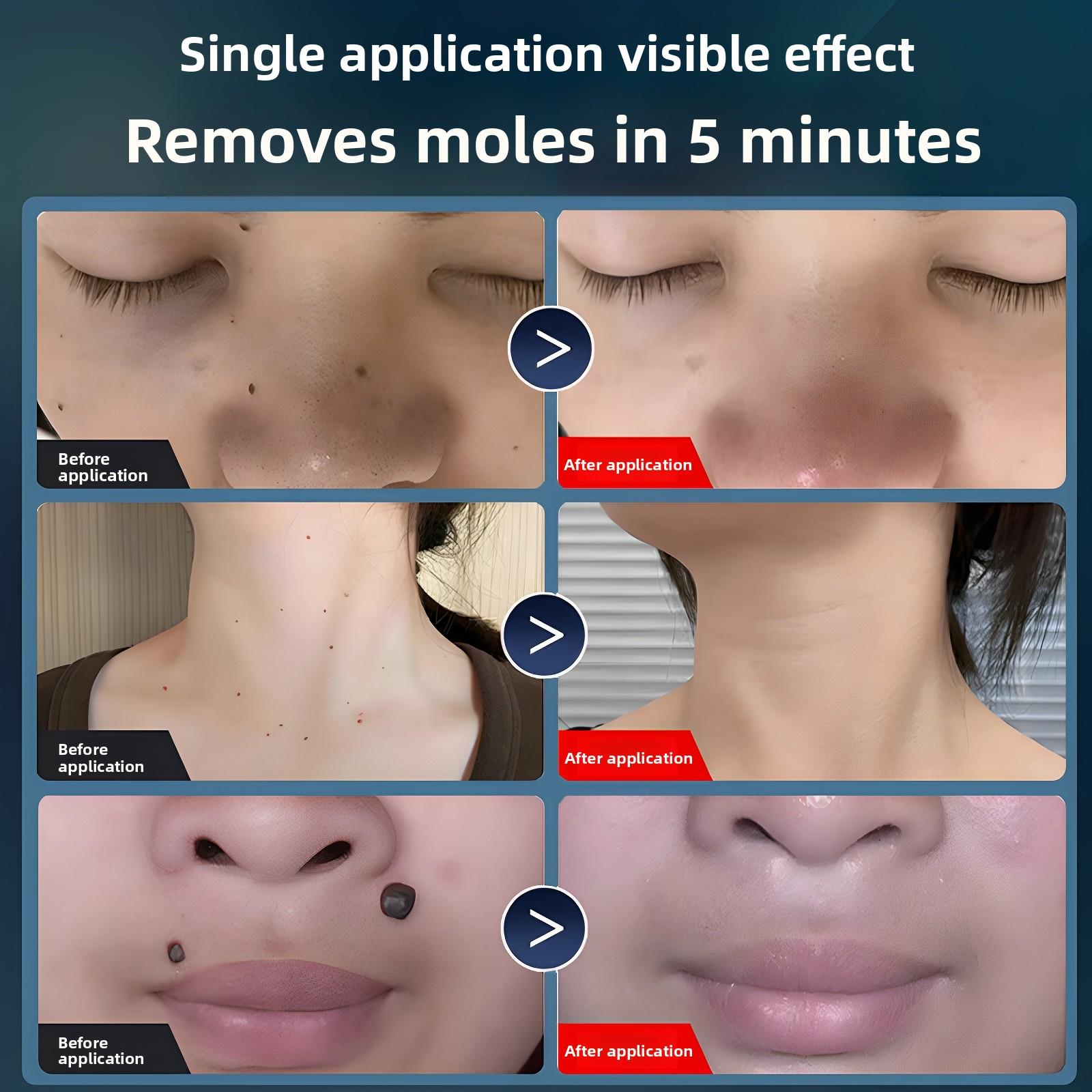 斑百世小白斑黑无品牌/痣激光去斑痣祛斑美容院笔专用祛仪痣祛斑