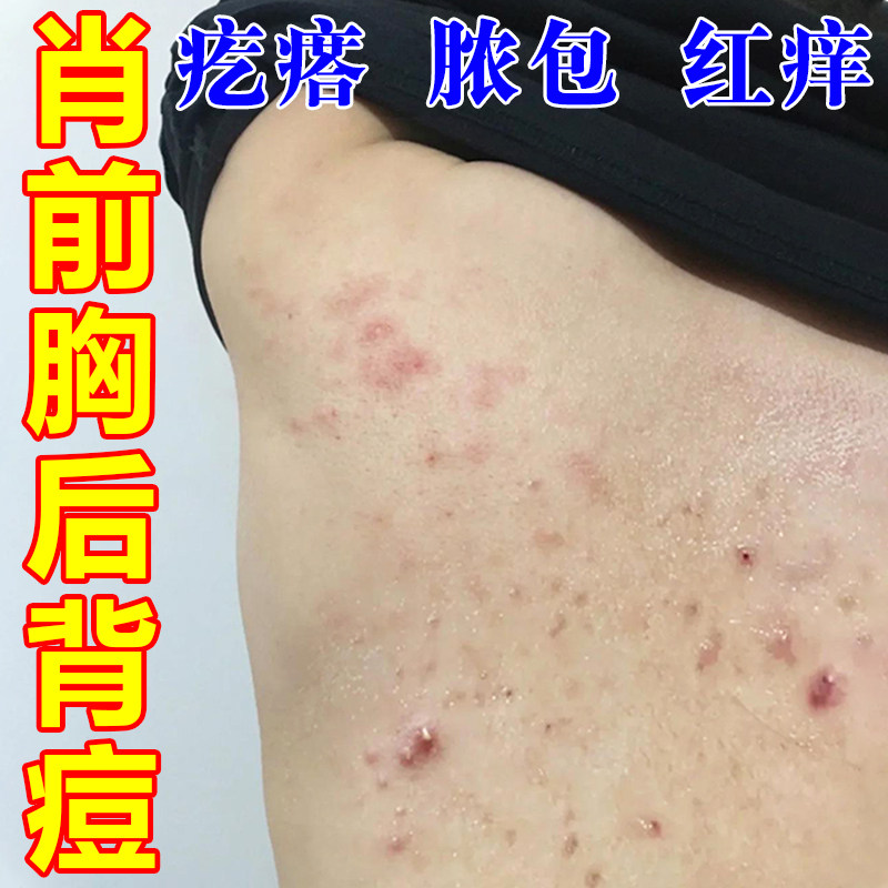 前胸后背长痘脂溢性身上背部起小疙瘩痒毛囊堵塞专用膏
