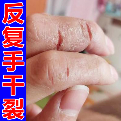 手裂的软膏手裂口干裂修复霜脚后跟手指裂口冻伤脱皮干燥愈合膏