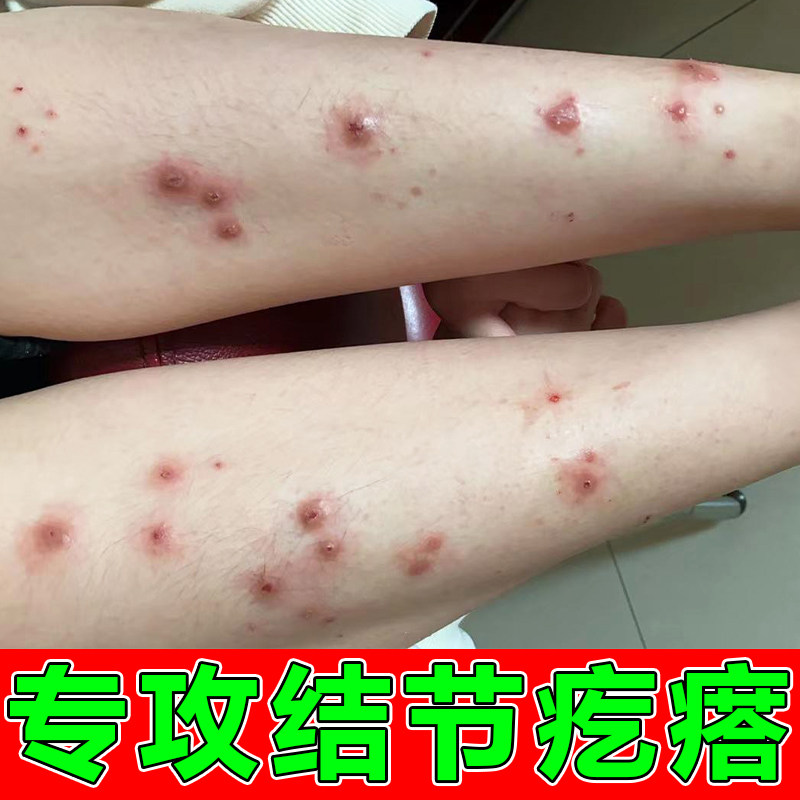 去顽固硬疙瘩小腿刺挠痒长小疙瘩结痂专用膏