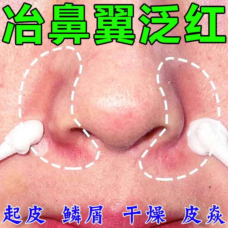 鼻子两侧发红脱皮鼻翼两边泛红干燥起皮掉皮痒酒糟鼻修复草本乳膏