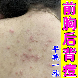 前胸后背痘背上长痘皮肤小红疙瘩用的软膏去除神器
