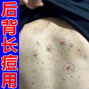 后背长痘身上痒起红疙瘩前胸后背红肿脓包马拉色菌软膏