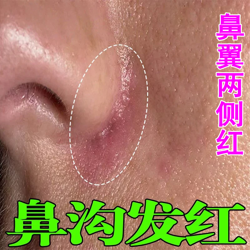鼻翼两侧泛红药鼻子发红干燥起皮皮肤消毒护理（消）