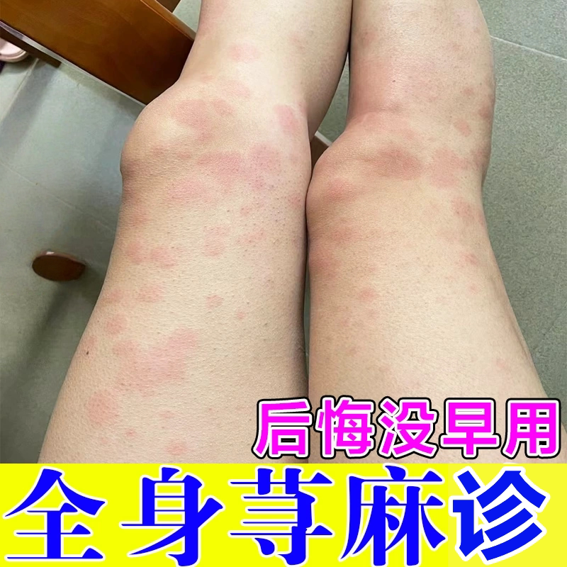 寻荨麻诊过敏专用冶慢急性本草皮皮肤消毒护理（消）