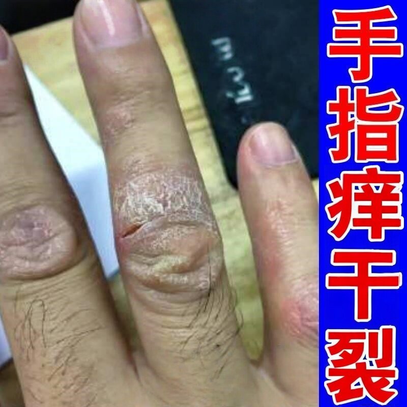 手指关节痒真菌硬皮顽固神经性皮皮肤消毒护理（消）