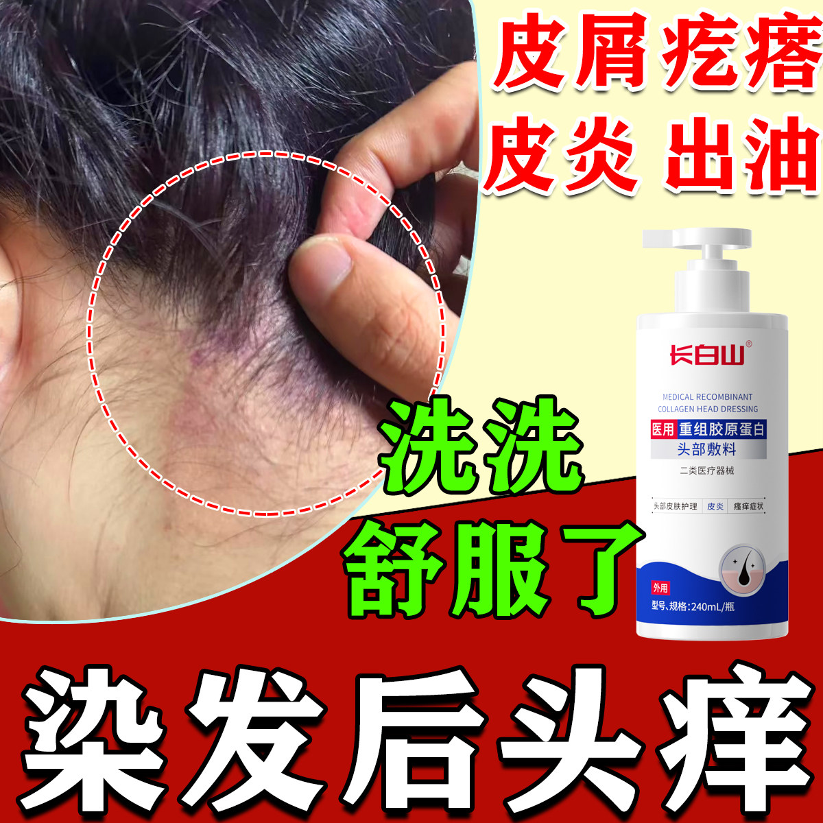 染发后头皮痒清洁头屑多起疙瘩脂溢性接触性皮炎毛囊炎护理洗发水