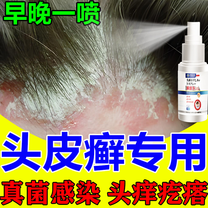 头皮癣专用头皮屑脂溢性皮炎真菌感染头皮痒起疙瘩毛囊炎头藓喷剂