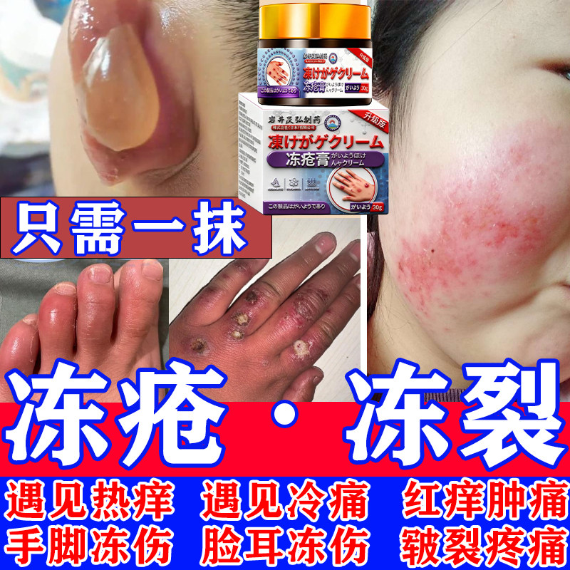 冻疮膏止痒消肿当晚看表现