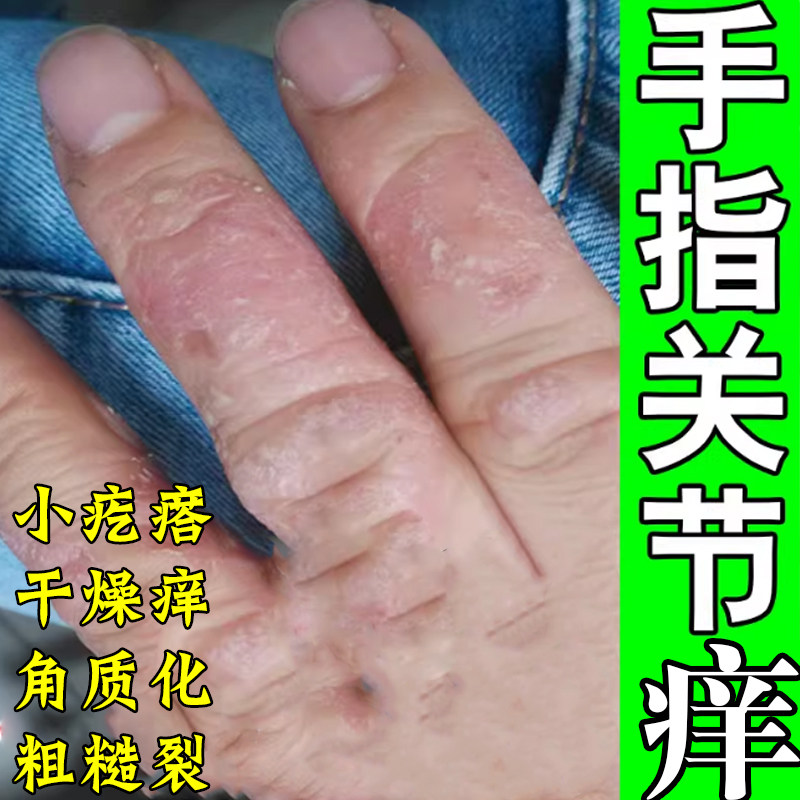 手指关节痒真菌感染开裂药手指关节长硬疙瘩伤痒脱皮干裂口手痒膏