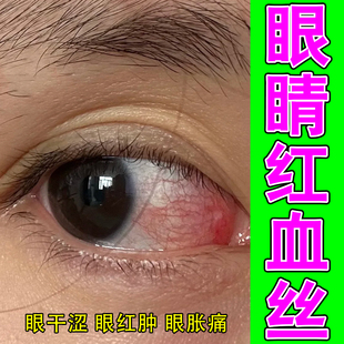 眼睛红血丝眼干涩红肿发痒视线模糊眼里有异物黄斑药