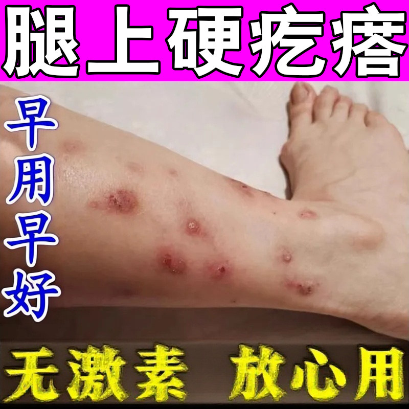 顽固硬疙瘩胳膊小腿痒蚊虫叮咬跳蚤痒抓挠破结痂红肿痘专用修护药
