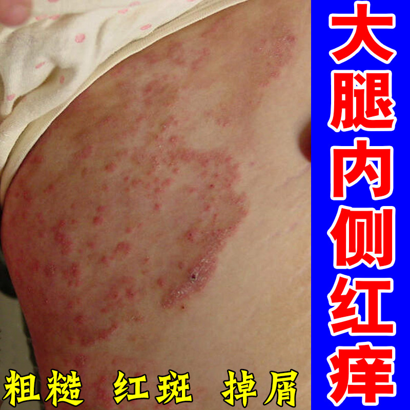 大腿内侧痒大腿两侧长红斑痘痘皮肤潮红肿真菌起疙瘩