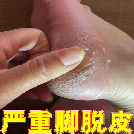 脚脱皮干裂去死皮去老茧足跟开裂皴裂真菌防开裂脱皮草本修复软膏