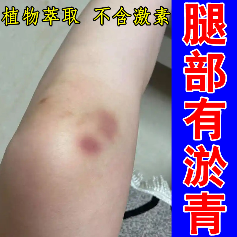 大腿外侧碰撞乌青斑块小腿皮下暗色印记莫名出现腿部青斑皮肤表层