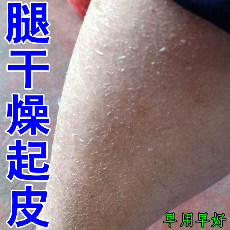 冶蛇皮肤鱼鳞皮腿部起皮掉屑肌肤粗糙手臂干纹全身干燥角质润肤霜