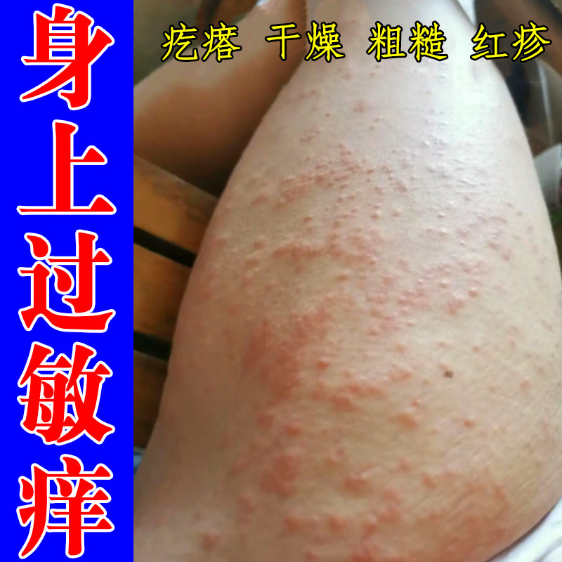 身上过敏长红疙瘩荨麻老年人皮肤痒全身过敏痒红特应性外用修复药