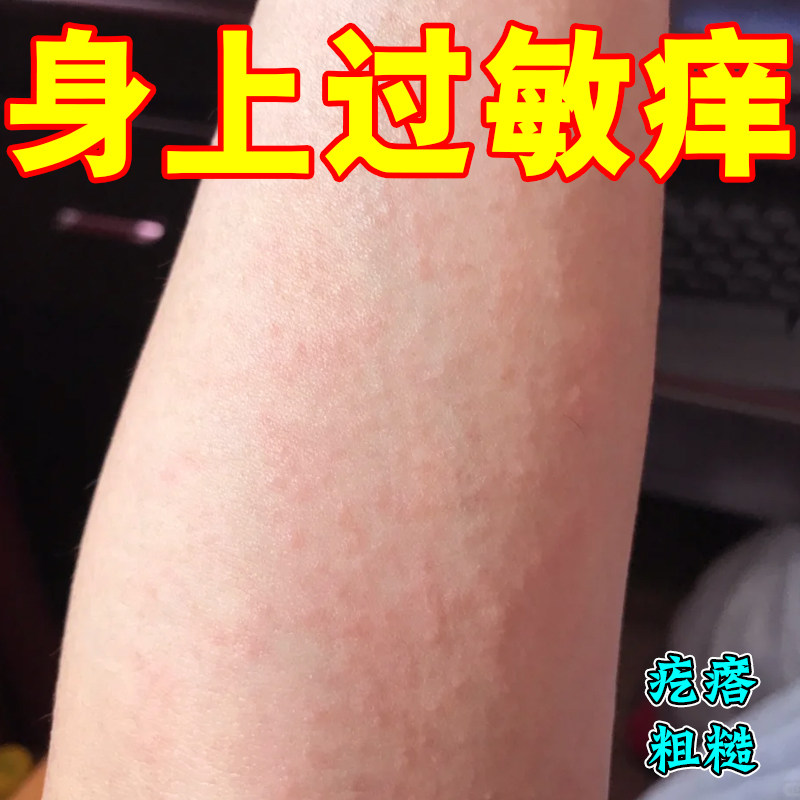身上过敏痒荨麻身上长红疙瘩皮肤干燥粗糙专用修护神器药
