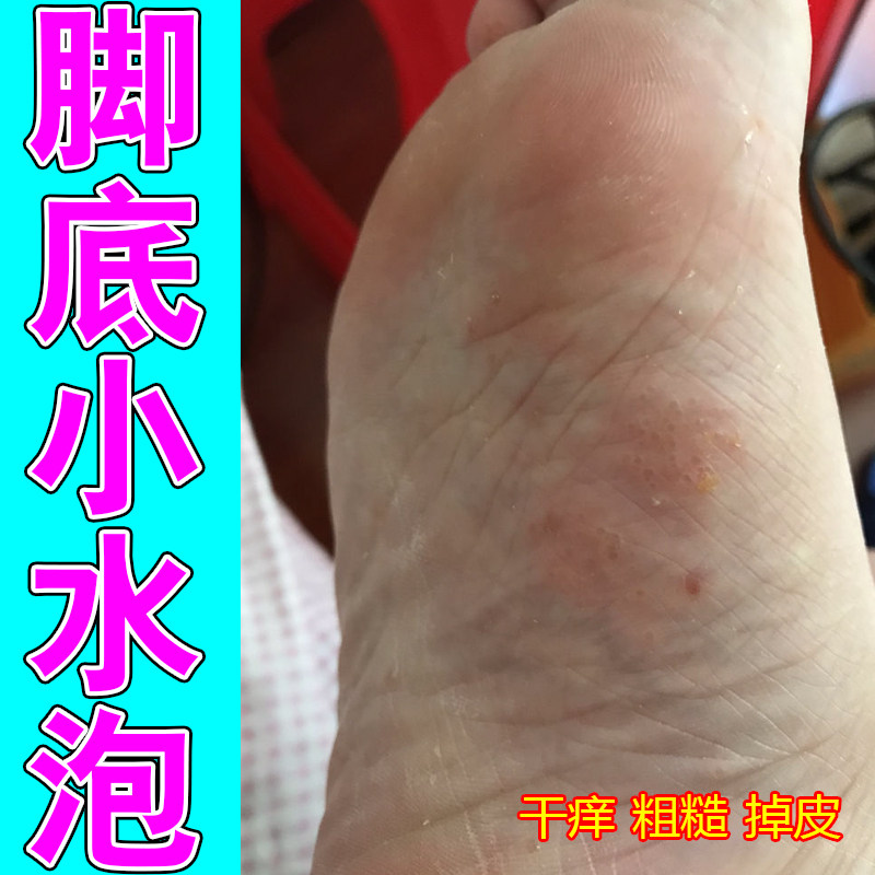 脚底小水泡红肿疙瘩脚痒脚出汗脱皮干燥痒粗糙痒专用草本膏
