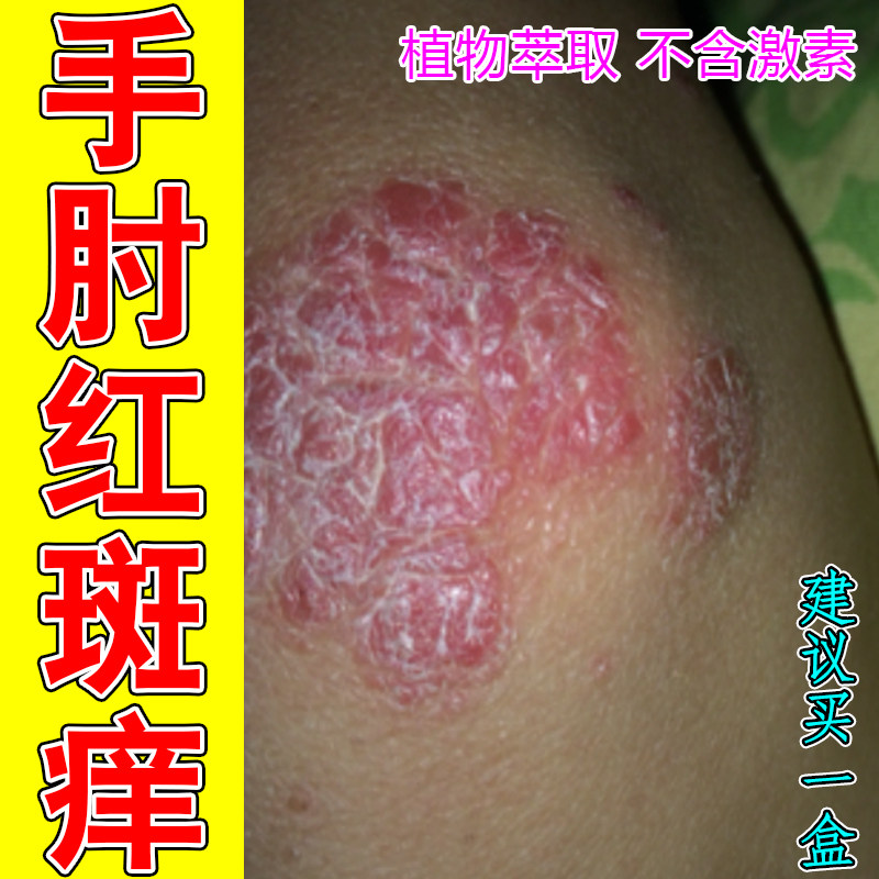 手肘红斑痒掉屑粗糙干燥红肿起皮神经性皮肤感染角质层增厚抓挠痒