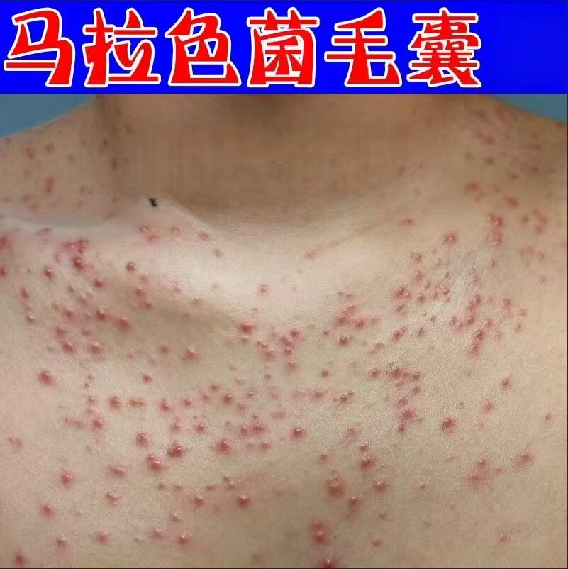 马拉色菌毛囊堵塞颗粒脖子前后胸前长痘痘有疙瘩后背毛囊痒药乳