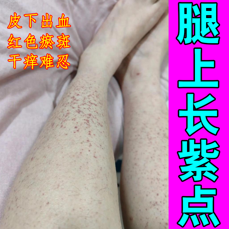 紫点冶色素过敏性紫点四肢皮下出血长红点瘀滞瘀斑皮肤红点修复药