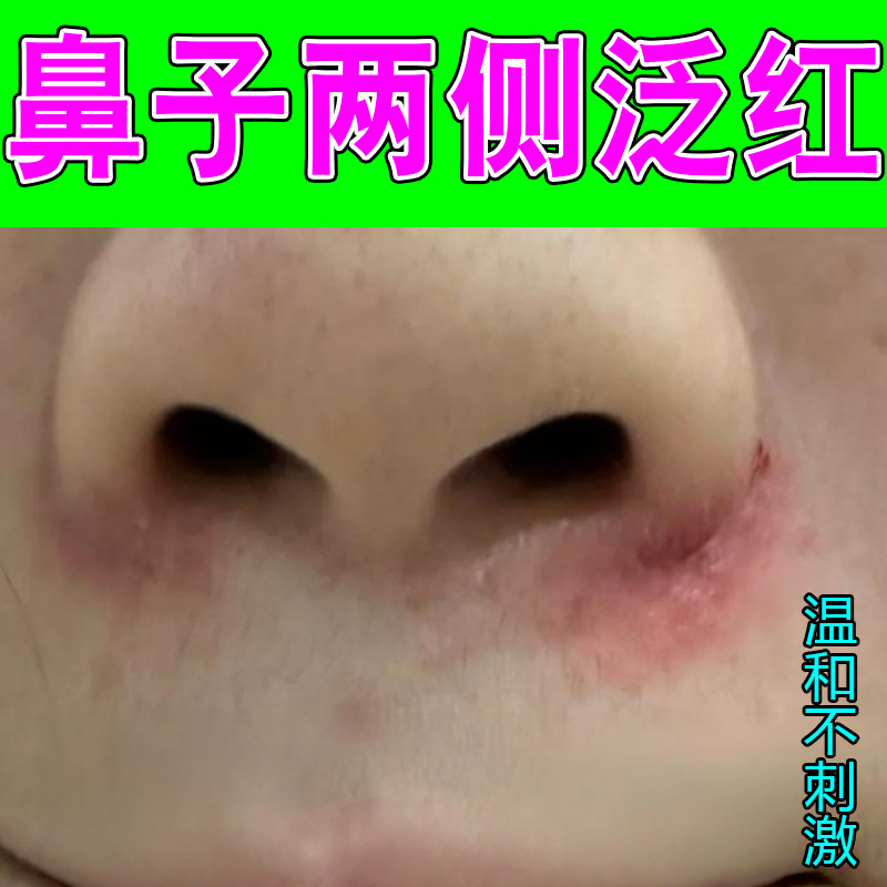 鼻子两侧泛红脱皮掉屑红肿痒脂溢性干燥蜕皮螨虫鼻周围过敏痒专用