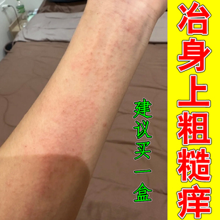 冶身上粗糙痒皮肤过敏起小红点小腿长痘痘疙瘩专用冬天干燥皮肤痒