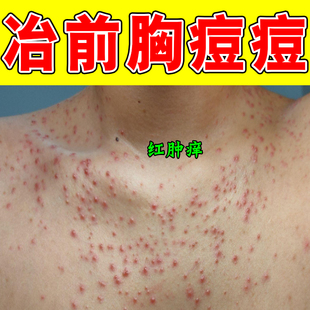 前胸后背长痘痘毛囊疙瘩马拉色菌除螨胸口长小红点发痒小疙瘩修复