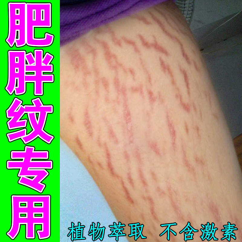 肥胖纹专用身上长白色红色纹路胳膊上腰腹上妊娠纹青少年学生修护