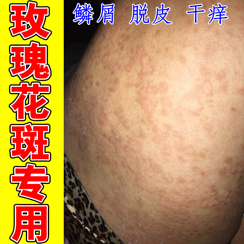 玫瑰糠疹专用膏药日光性过敏紫外线过敏太阳晒伤脂溢性长红斑疙瘩
