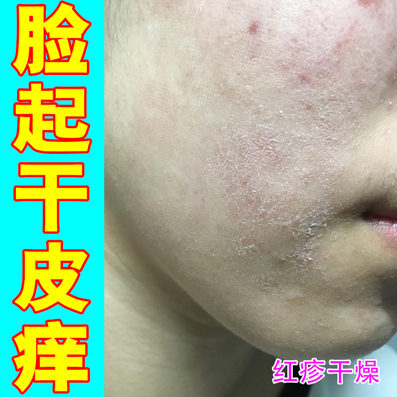 脸起皮干燥有碎屑皮肤粗糙红痒额头嘴角下巴起皮过敏痘痘专用修复
