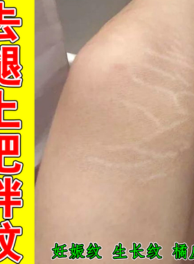 生长纹肥胖纹专用身上大腿长白色红色纹路妊娠纹青少年男女通用膏