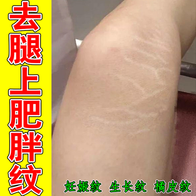 生长纹肥胖纹专用身上大腿长白色红色纹路妊娠纹青少年男女通用膏