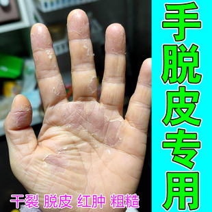 手脱皮专用皮肤干燥蜕皮裂口子秋冬手部粗糙角质层增厚剥脱性松懈