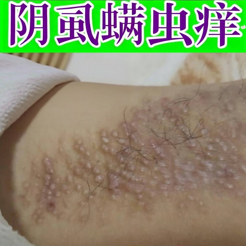 阴虱正品男女通用私处痒腋下沉着颗粒去除虱子灭阴虱虫卵咬痒药剂