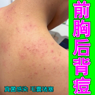 前胸后背痘身上痒起红疙瘩淋巴痘腮边痘马拉色菌螨虫痘痘