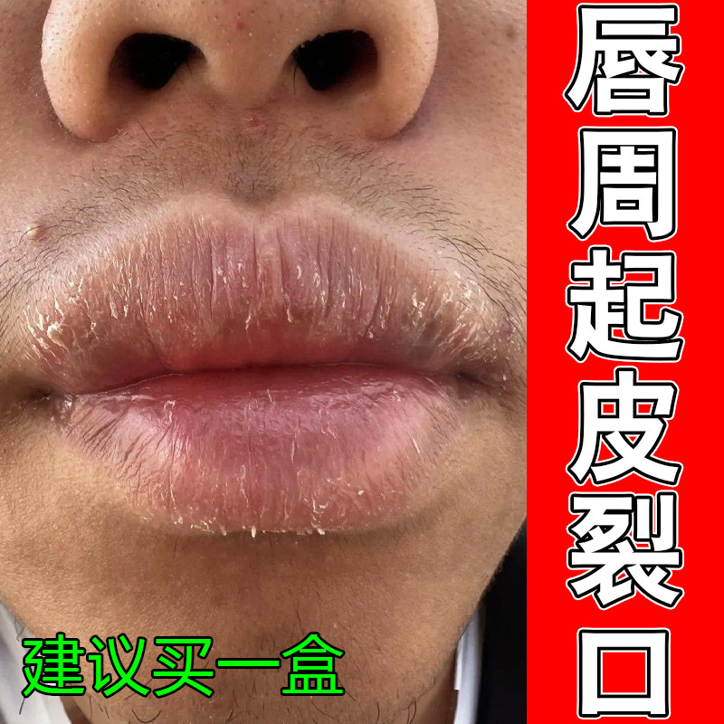 唇周起皮裂口专用儿童经常舔嘴唇干燥长水泡嘴角开裂红肿痒痛修复
