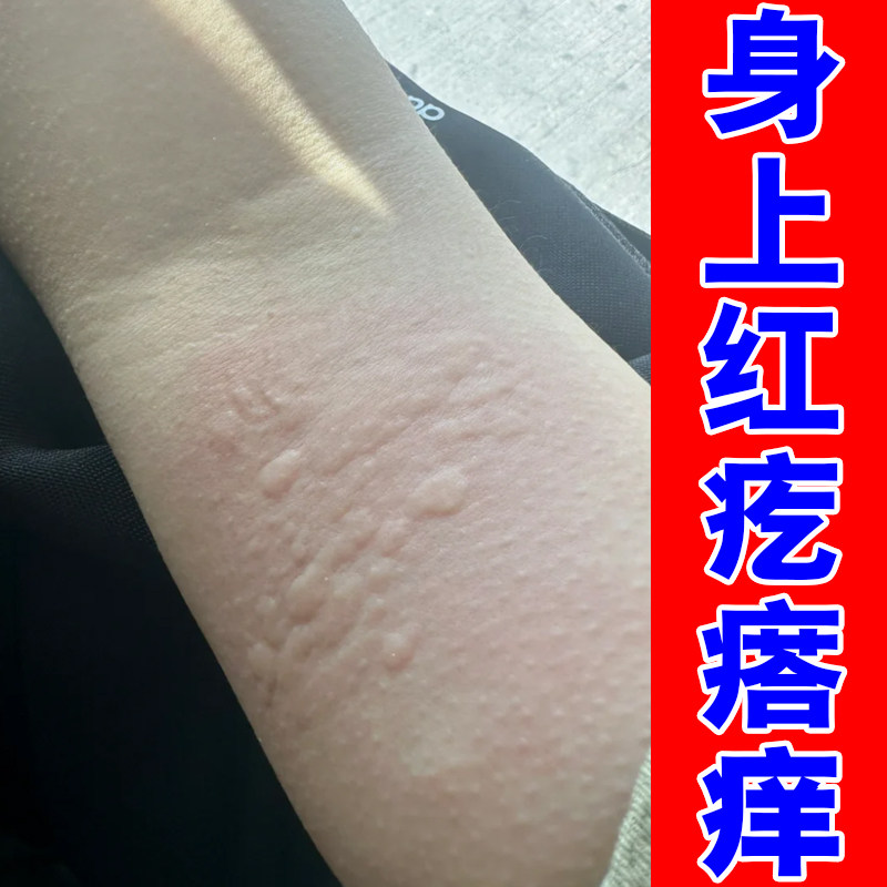 身上红疙瘩痒过敏起风团急慢性提高免疫力长红斑皮肤总痒草本修护