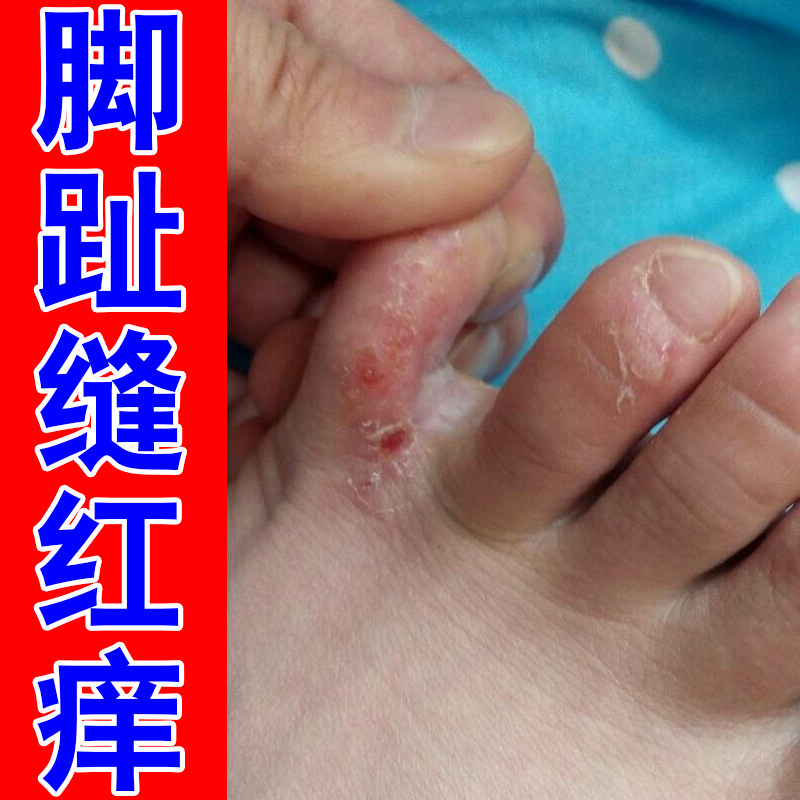 脚趾缝红痒皮肤干燥蜕皮脚臭汗脚长小水泡刺挠抓挠痒感染专用草本