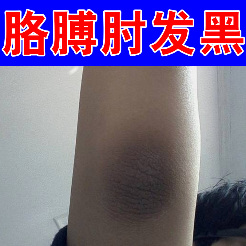 胳膊肘发黑胳肢窝手指关节腋下黑色素沉淀淡化皮肤干粗糙叮咬黑印