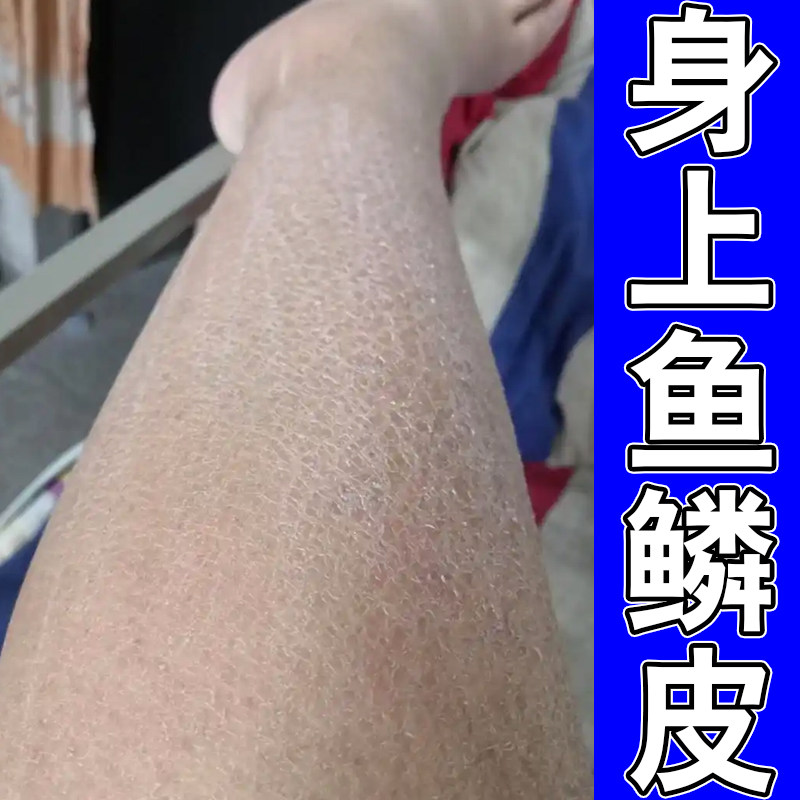 身上腿上干燥起皮小腿皮肤粗糙干裂学生成人身上掉皮屑鱼鳞去死皮