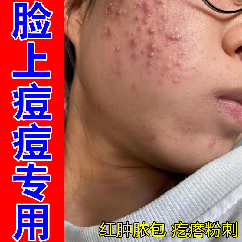 脸上痘痘专用内分泌失调上火熬夜皮肤消毒护理（消）