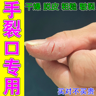 手裂口专用干燥脱皮粗糙裂口手指缝裂口子指甲缝开裂修复药乳膏